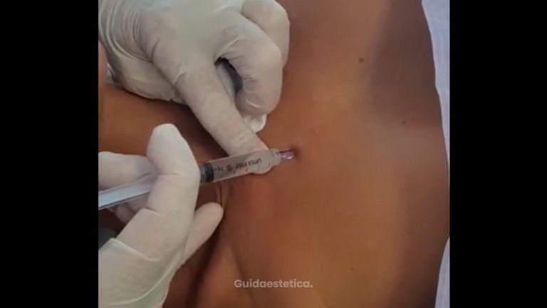 Mesoterapia - Tuamedica