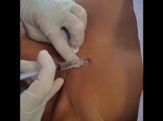 Mesoterapia - Tuamedica