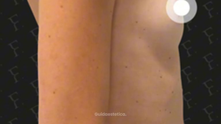 Prof. Giuseppe A. Ferraro Risultato estetico di una mastoplastica additiva con effetto naturale