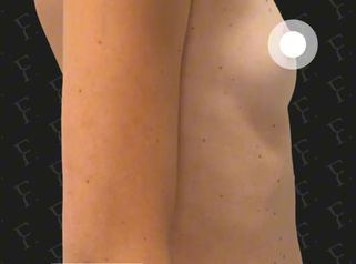 Prof. Giuseppe A. Ferraro Risultato estetico di una mastoplastica additiva con effetto naturale