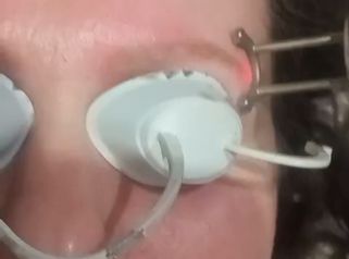 Dott.ssa Cornelia Florea Eliminazione pigmento sopracciglia