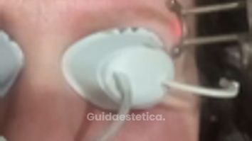 Dott.ssa Cornelia Florea Eliminazione pigmento sopracciglia