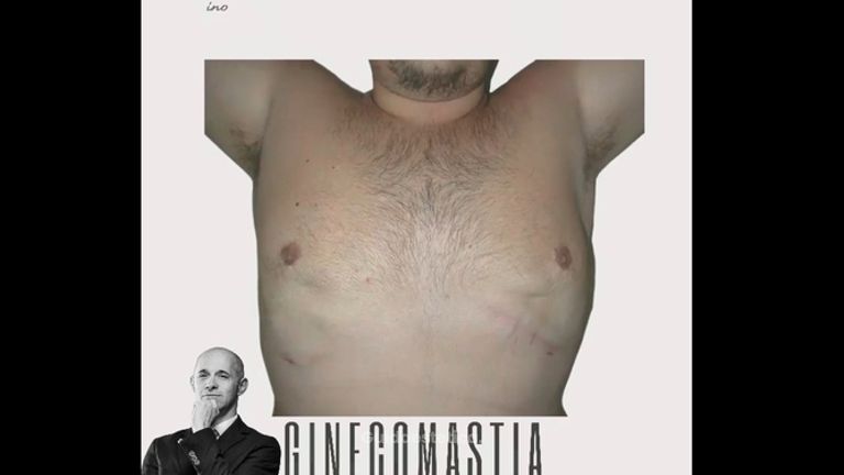 Ginecomastia - Aesthetic Clinic del Dott. Giulio Maria Maggi