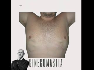 Ginecomastia - Aesthetic Clinic del Dott. Giulio Maria Maggi