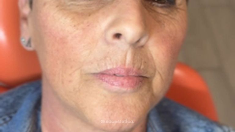 Dott.ssa Sara Carinci Video risultato prima e dopo Filler labbra