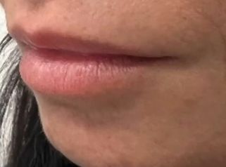 Dott. Giovanni Migliorini Filler Labbra