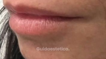 Dott. Giovanni Migliorini Filler Labbra