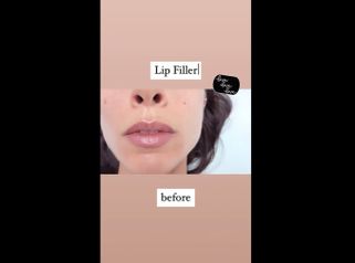 Filler labbra - Dott.ssa Paola Nardolillo