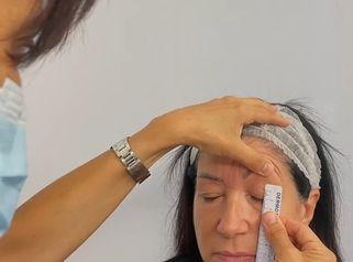 Dott.ssa Silvia Scevola Chirurgia plastica di precisione per la blefaroplastica superiore.