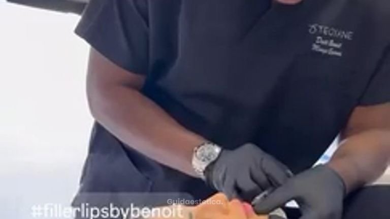 Venini Ventitre Medical Center Filler labbra: come si applica e quali risultati aspettarsi