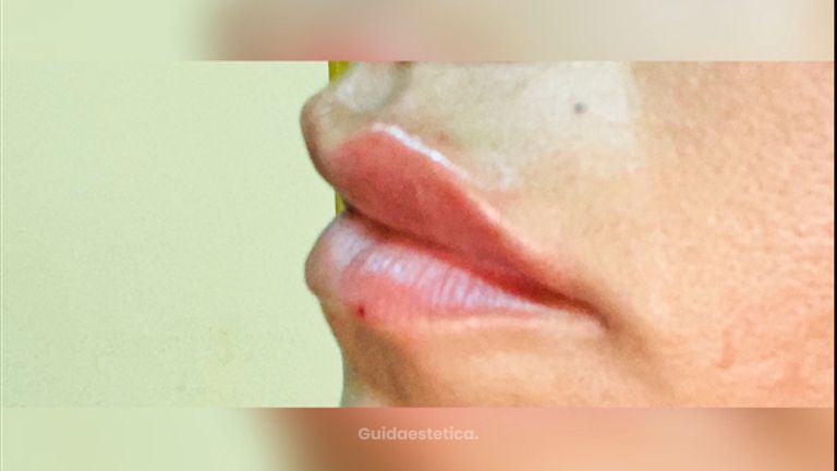Tecnica lip contour: definizione delle labbra senza aumento volumetrico