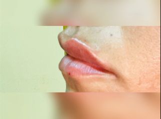 Tecnica lip contour: definizione delle labbra senza aumento volumetrico