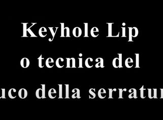 Dott. Santoro Maurizio - Tecnica Keyhole Lip o "Buco della Serratura"