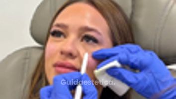 Faceland Ridefinire gli zigomi con filler