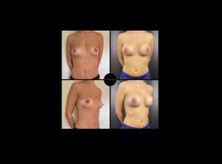 Matoplastica Additiva - Excelsa Aesthetic Medicine