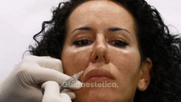 I Filler a base di acido ialuronico