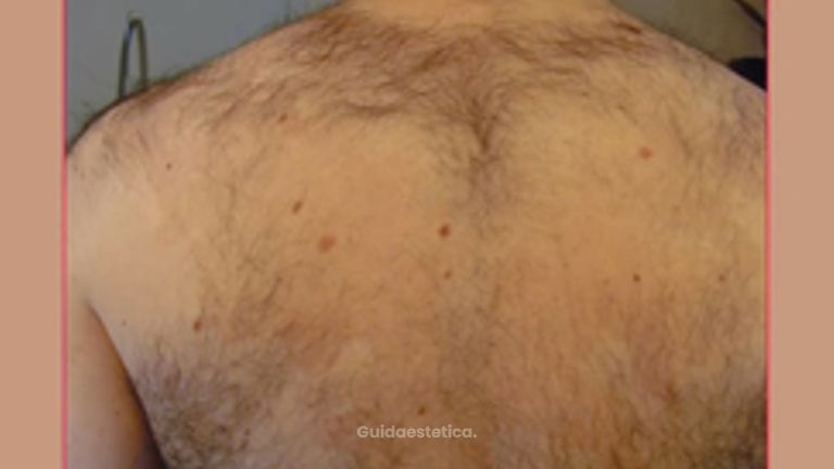 Laserepilazione corpo