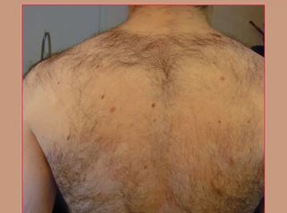 Laserepilazione corpo