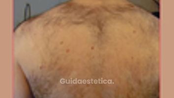Laserepilazione corpo