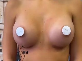 Venini Ventitre Medical Center Protesi seno 400 cc e tecnica dual plane Dott. Benoit Menye