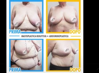 Mastoplastica riduttiva e addominoplastica