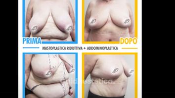 Mastoplastica riduttiva e addominoplastica