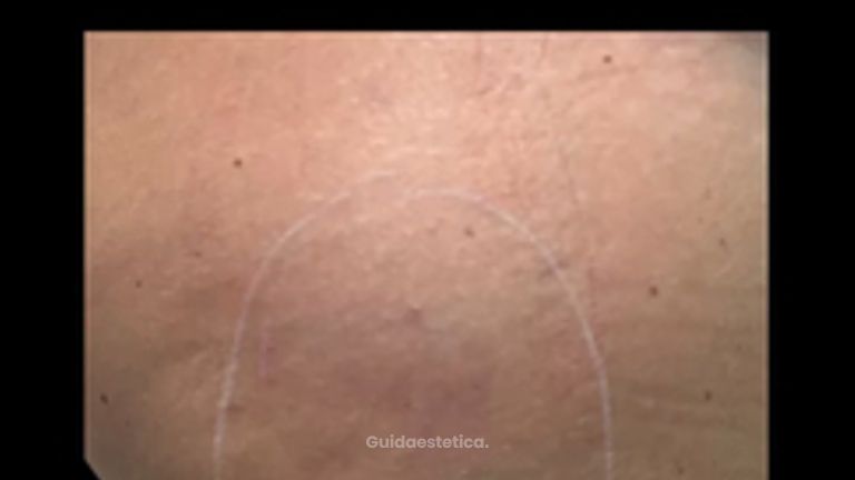 Dott. Giovanni Migliorini Carbossiterapia trattamento con CO₂