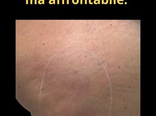 Dott. Giovanni Migliorini Carbossiterapia trattamento con CO₂