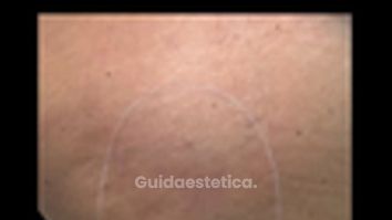 Dott. Giovanni Migliorini Carbossiterapia trattamento con CO₂