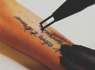 Rimozione tattoo