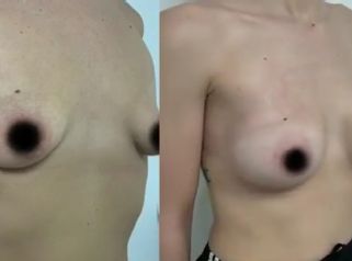 Mastoplastica Additiva - Dr. Giuseppe Cuccia