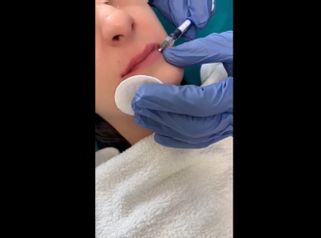 Filler labbra - Dott. Dauro Reale