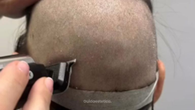 Trapianto capelli Dr Giuliano