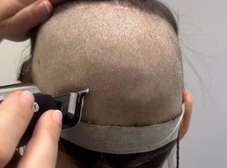 Trapianto capelli Dr Giuliano