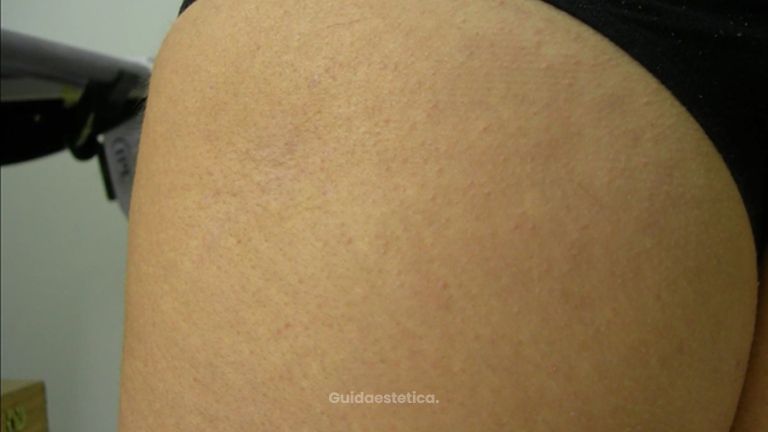 Presentazione glutei