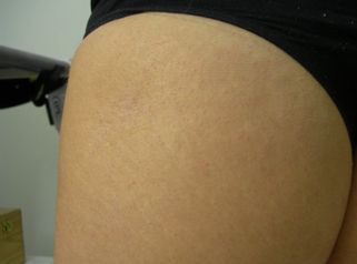 Presentazione glutei
