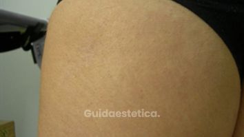 Presentazione glutei