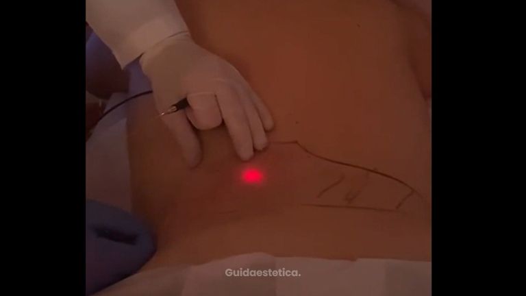 Endolift - Dott. Raffaele Merola