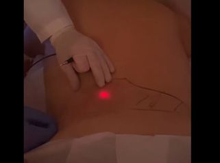 Endolift - Dott. Raffaele Merola