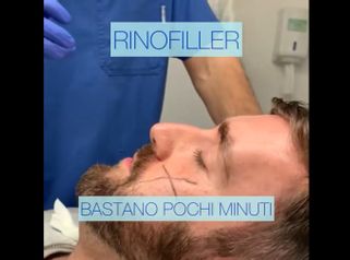 Rinofiller - Medicina Estetica Equilybra