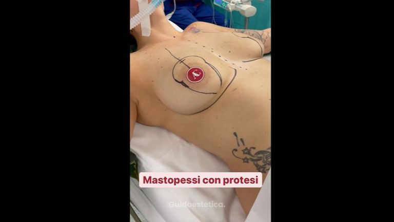 Mastopessi - Dott. Alessandro Covacivich