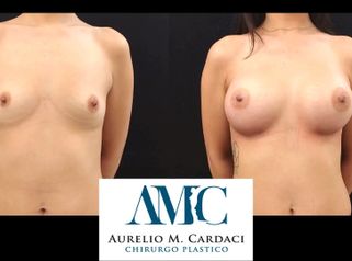 Mastoplastica additiva - Dott. Aurelio M. Cardaci