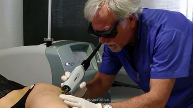 Trattare i capillari coi laser 