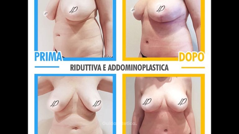 Mastoplastica riduttiva e addominoplastica