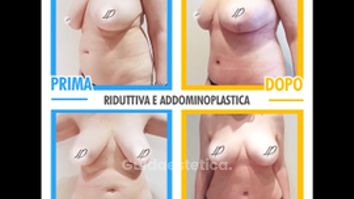 Mastoplastica riduttiva e addominoplastica