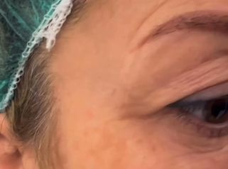 Venini Ventitre Medical Center Palpebra superiore cadente Dott. Benoit Menye