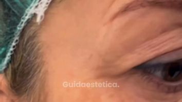 Venini Ventitre Medical Center Palpebra superiore cadente Dott. Benoit Menye