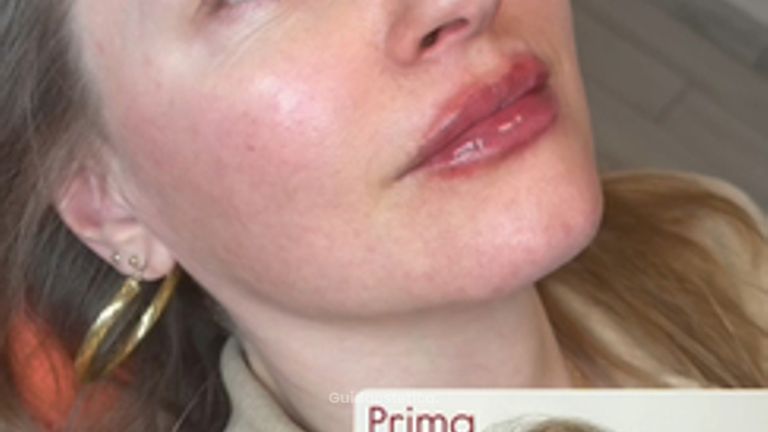 Dott.ssa Sara Carinci Ringiovanimento viso: prima e dopo su paziente