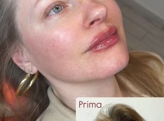 Dott.ssa Sara Carinci Ringiovanimento viso: prima e dopo su paziente