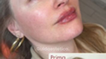 Dott.ssa Sara Carinci Ringiovanimento viso: prima e dopo su paziente